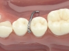 DYNAFLEX BALL CLASP - - alt view 1