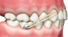 PRECISION ALIGNER BUTTON - - alt view 2