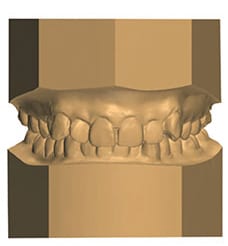 ABO Study Model Prints